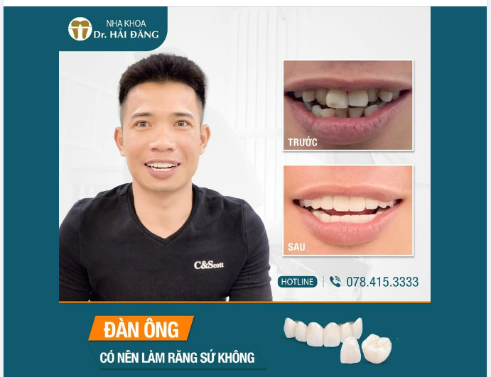 ĐÀN ÔNG CÓ NÊN BỌC RĂNG SỨ ???