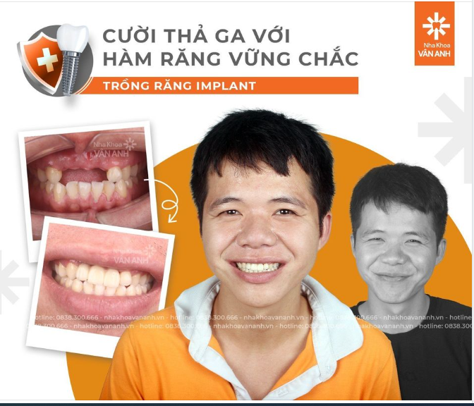 "Anh cười mỉm thôi được không, mất răng cười ngại lắm"