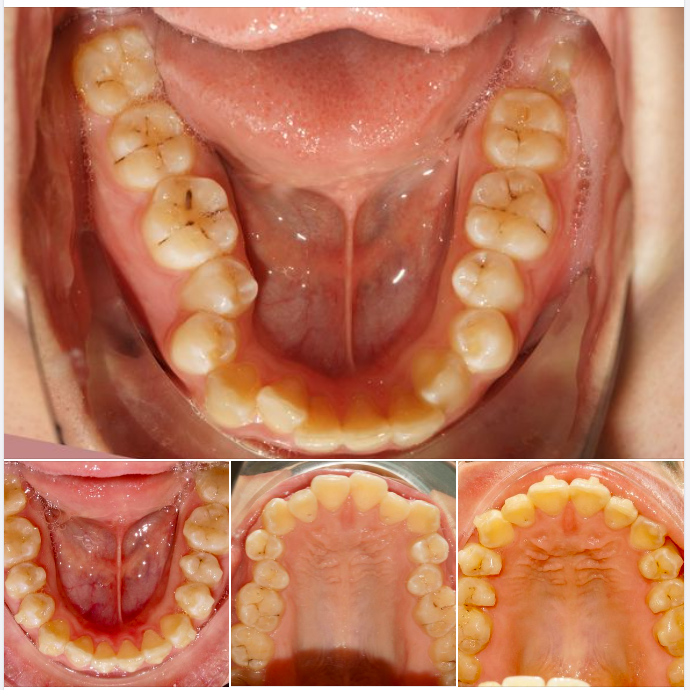 Nhiều khả năng bạn sẽ cần phải nhổ răng nếu muốn niềng răng trong trường hợp này...