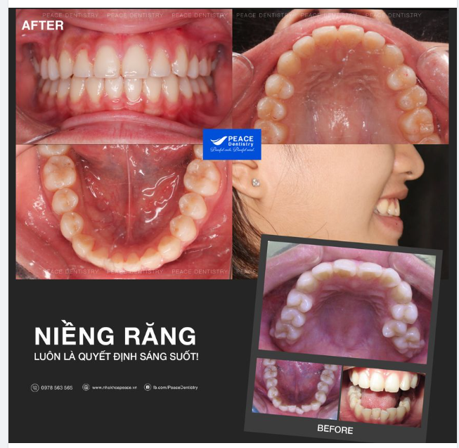 Sau gần 2 năm niềng răng, những nỗ lực, kiên trì của H.A được đền đáp xứng đáng. Bạn ngày càng rạng rỡ, xinh xắn và tự tin hơn.
