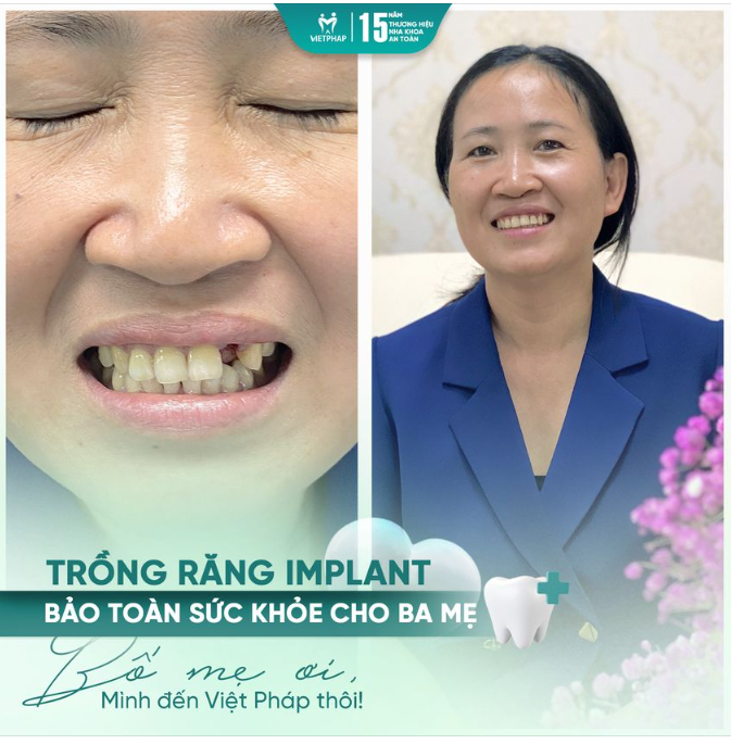 Trồng răng implant - Bảo toàn sức khỏe cho ba mẹ