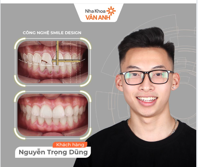 SỨT MẺ RĂNG CỬA - XỬ LÝ NHƯ THẾ NÀO??