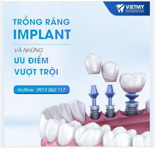 CẤY GHÉP IMPLANT CÓ NHỮNG ƯU ĐIỂM VƯỢT TRỘI NÀO ??