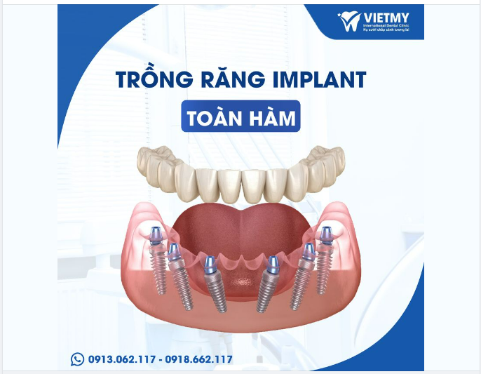 NHỮNG ƯU ĐIỂM VƯỢT TRỘI KHI TRỒNG RĂNG TOÀN HÀM