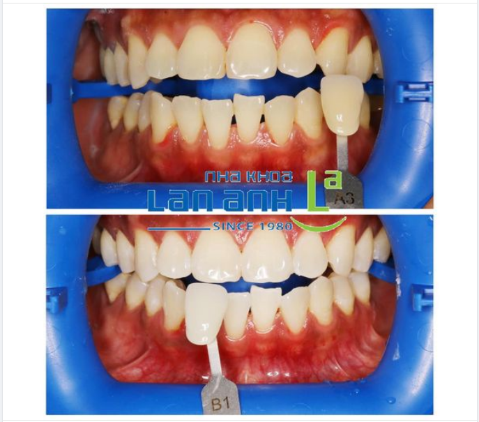 Với nhu cầu thẩm mỹ của mỗi khách hàng là khác nhau, Nha khoa Lan Anh luôn hướng Khách hàng đến kế hoạch điều trị sao cho đạt hiệu quả về chuyên môn, thẩm mỹ cũng như về kinh tế.