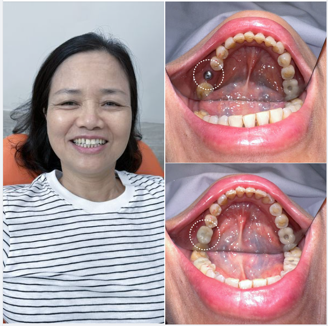 TRỒNG RĂNG IMPLANT-SỰ ĐẦU TƯ CHÍNH ĐÁNG !