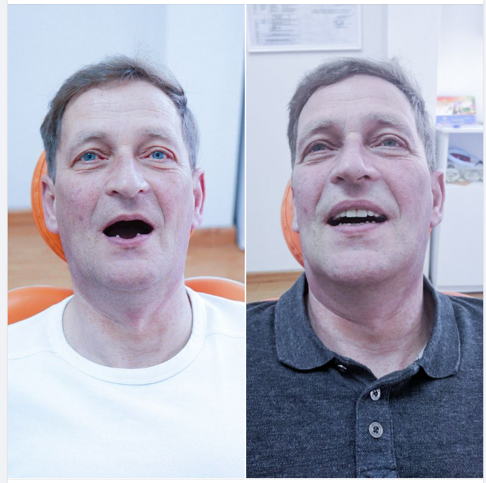 NGƯỜI NƯỚC NGOÀI MẤT RĂNG TẠI VIỆT NAM PHẢI LÀM SAO?