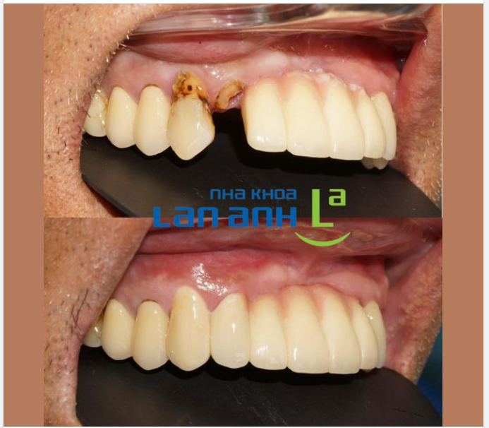 Bệnh nhân lớn tuổi, không có nhiều thời gian để làm răng, thì cầu răng là giải pháp hiệu quả, đặc biệt ở những trường hợp chịu lực ít, khoảng trống mất răng nhỏ