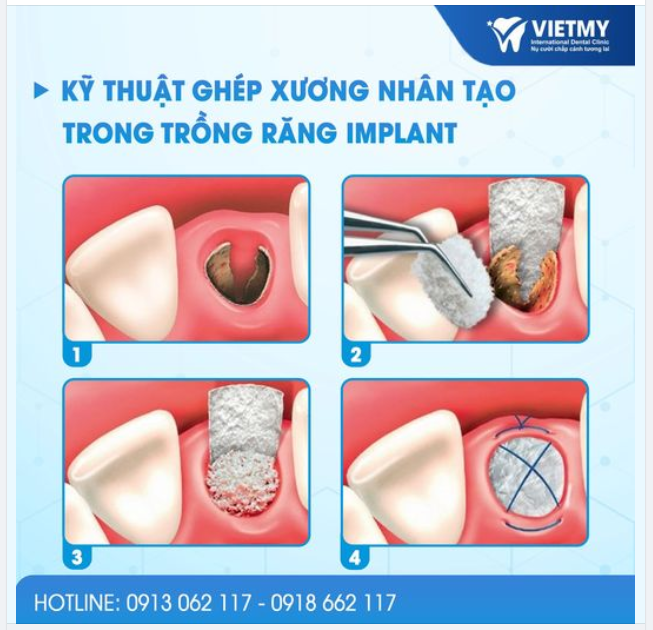 KỸ THUẬT GHÉP XƯƠNG NHÂN TẠO TRONG TRỒNG RĂNG IMPLANT