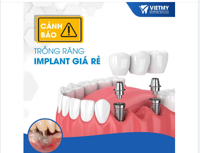 CẢNH BÁO TRỒNG RĂNG IMPLANT GIÁ RẺ- CHÍNH LÀ MUA RỦI RO VÀO BẢN THÂN.