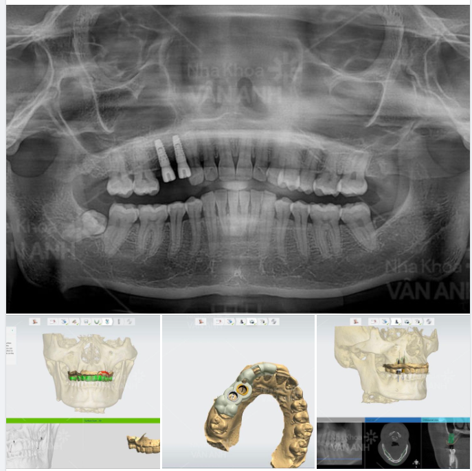 Cập nhật kỹ thuật, công nghệ hiện đại nhất vào khám chữa, Nha khoa Vân Anh đang là địa chỉ trồng implant được nhiều khách hàng ưu tiên chọn lựa.