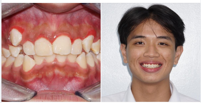 Hồi xưa răng bạn lệch lạc chen chúc nhiều lắm…Mà giờ thì đẹp trai hơn nhiều rồi