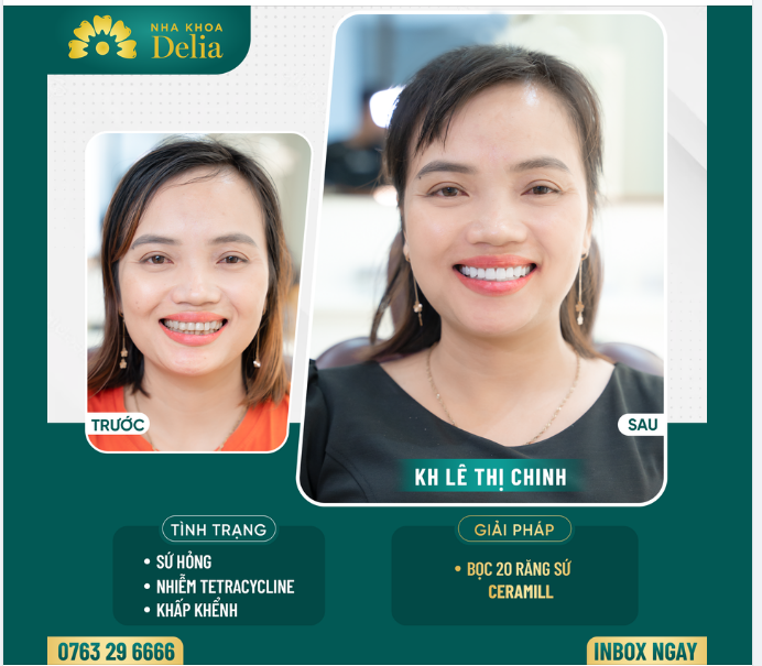 Kiều bào Mỹ thẩm mỹ răng sứ - 48h có ngay nụ cười khỏe đẹp rạng rỡ