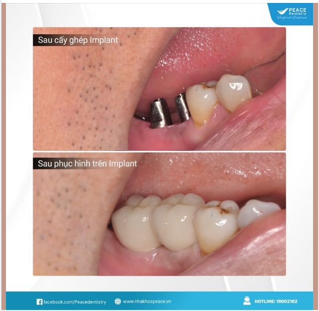 Cận cảnh sau khi cấy ghép implant và phục hình cho thấy vì sao Implant là lựa chọn được ưu tiên hàng đầu khi mất răng.
