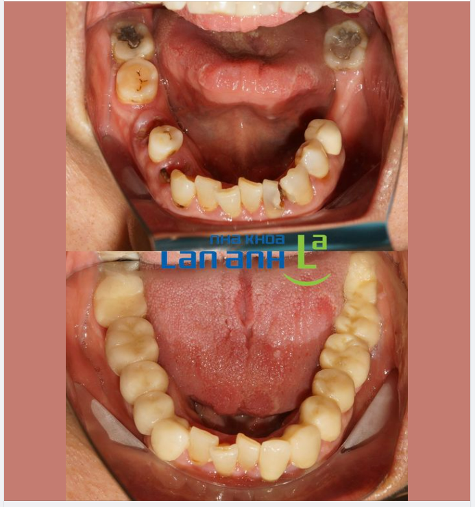 Cầu răng có thể phục hồi sức nhai của bạn một cách nhanh chóng, giúp "trồng răng" lại ngay lập tức chỉ sau 3 ngày.