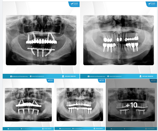 Cấy ghép implant phục hình tức thì: Khách hàng có thể ăn nhai với "răng Implant" chỉ sau 7 ngày.
