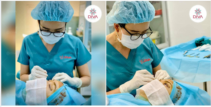 THẨM MỸ MẮT MUỐN NẾP MÍ ĐẸP TỰ NHIÊN BẠN CẦN BIẾT ĐIỀU NÀY