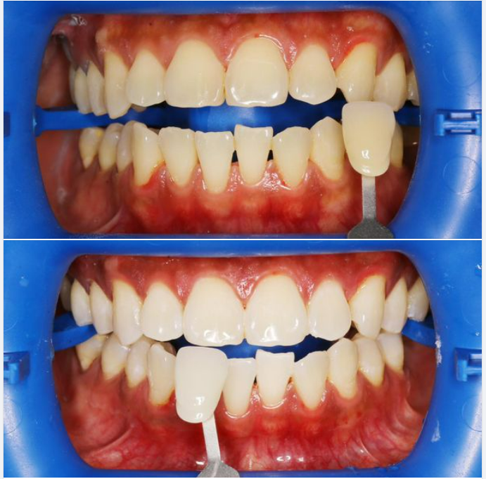 Tẩy trắng răng tại nha khoa, kết quả có được ngay sau 1 giờ