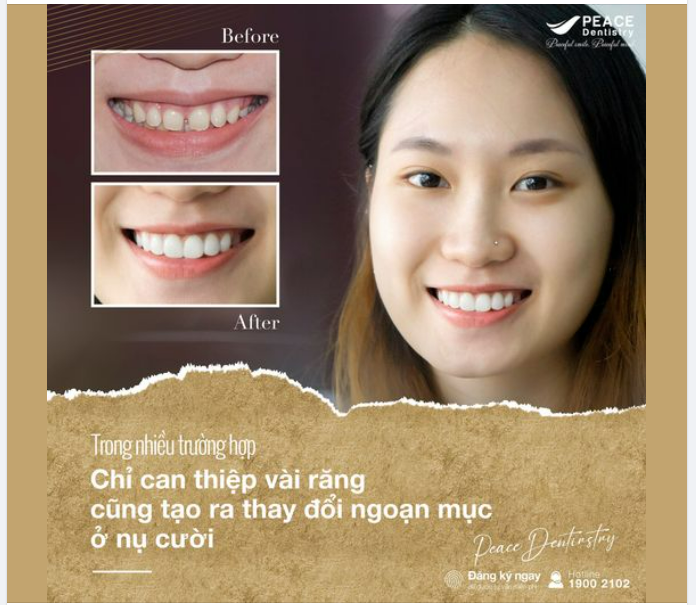 NỤ CƯỜI TOÀN DIỆN CHUẨN NÉT XINH