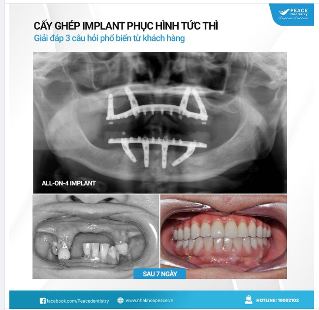 TRỒNG RĂNG IMPLANT CÓ THỂ GẮN RĂNG LÊN IMPLANT SAU 7 NGÀY HAY KHÔNG?