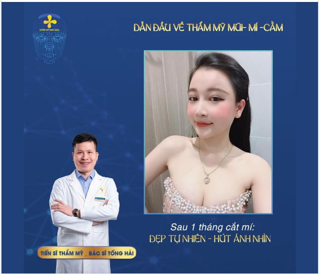 Feedback sau hơn 1 tháng cắt mí.