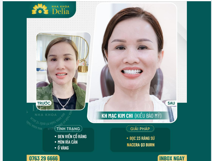 Chị Mạc Kim Chi (kiều bào Mỹ) đến với nha khoa Delia mong muốn xử lý các tình trạng: