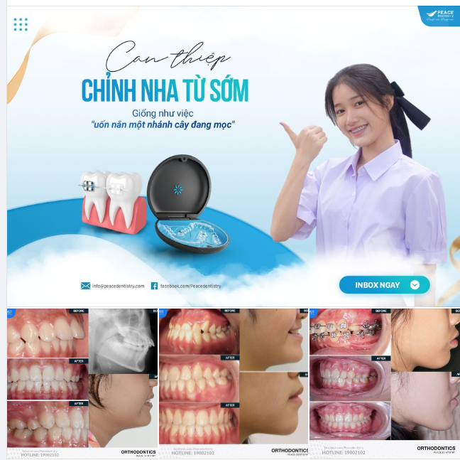 ĐỪNG BỎ LỠ THỜI ĐIỂM VÀNG ĐỂ NIỀNG RĂNG CHO BÉ!