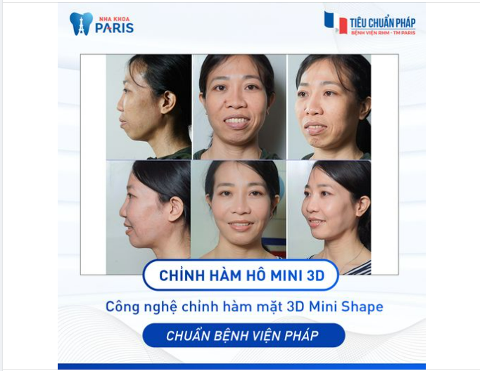 Tại sao lại gọi là Phẫu thuật chỉnh hàm hô Mini 3D?