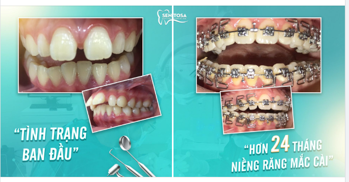GIÁ TRỊ LỚN KHI NIỀNG RĂNG MẮC CÀI HƠN 24 THÁNG