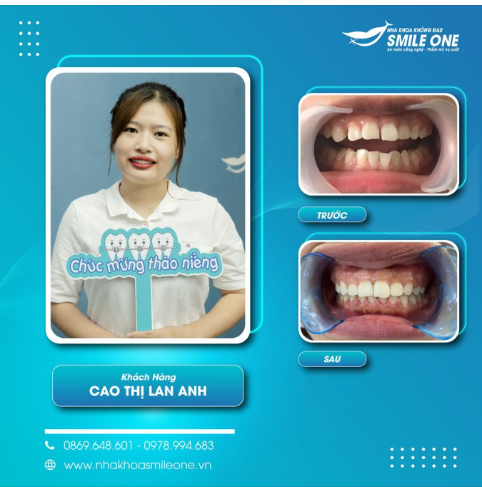Hành trình vượt hơn 130km để niềng răng của cô gái Nam Định!