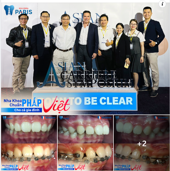 Khí cụ Carre giúp đưa khớp cắn Hạng II về Hạng I sau 5 tháng
