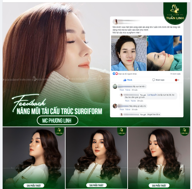 Feedback nâng mũi tái cấu trúc sụn Surgiform