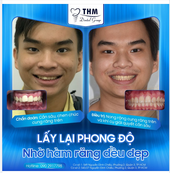 LẤY LẠI PHONG ĐỘ NHỜ HÀM RĂNG ĐỀU ĐẸP CÙNG NHA KHOA THẾ HỆ MỚI
