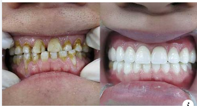 Phương pháp làm răng dài nào được áp dụng phổ biến hiện nay?