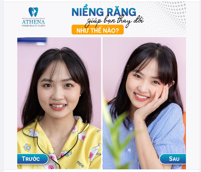 NIỀNG RĂNG GIÚP BẠN THAY ĐỔI NHƯ THẾ NÀO?
