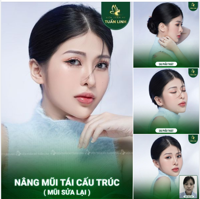 NÂNG MŨI SỬA LẠI - DÁNG MŨI SAU 5 NĂM