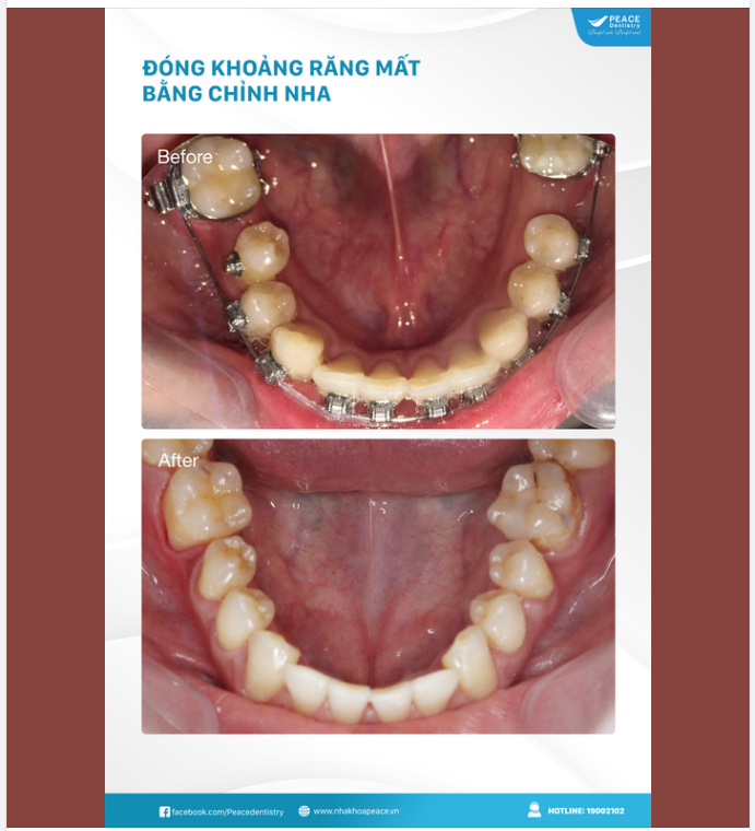 ĐÓNG KHOẢNG RĂNG MẤT BẰNG CHỈNH NHA