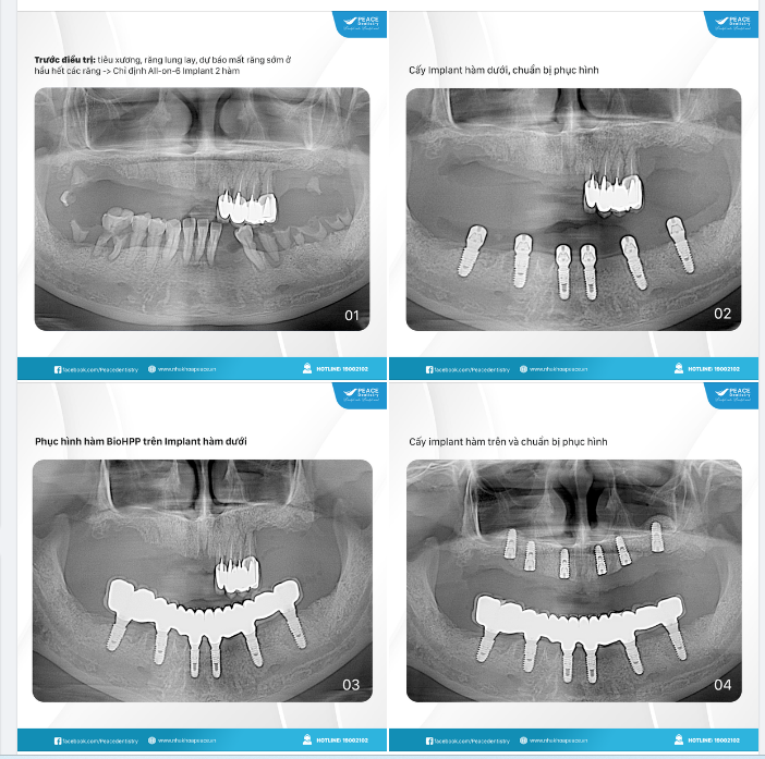 QUYẾT ĐỊNH TRỒNG IMPLANT TỪ SỚM MANG LẠI NHIỀU LỢI ÍCH