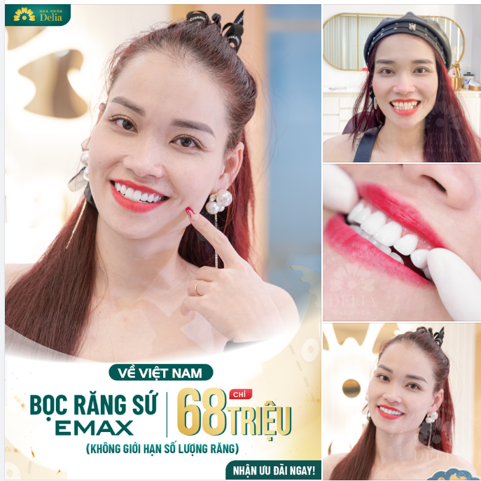 Bọc răng sứ - Khắc phục răng hô, ố vàng cho kiều bào Singapore