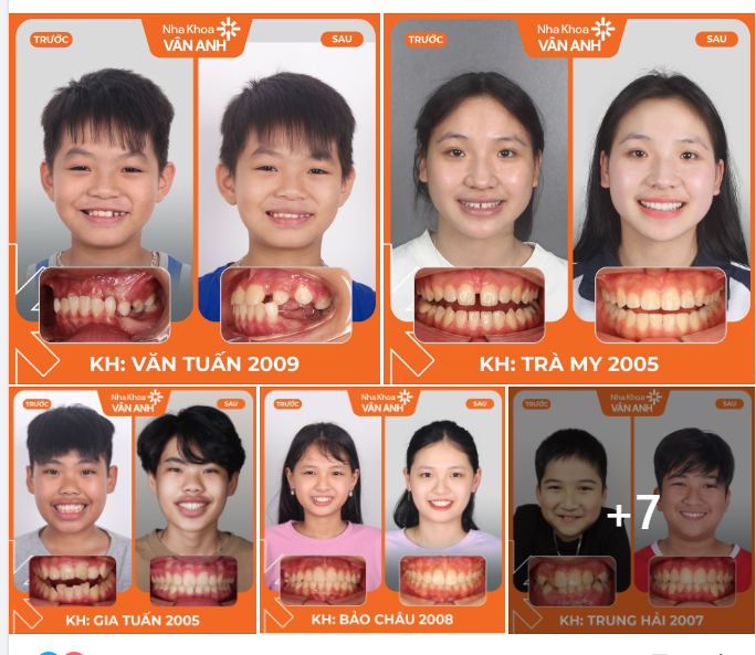 TẠI SAO NÊN NIỀNG RĂNG CHO TRẺ TỪ SỚM