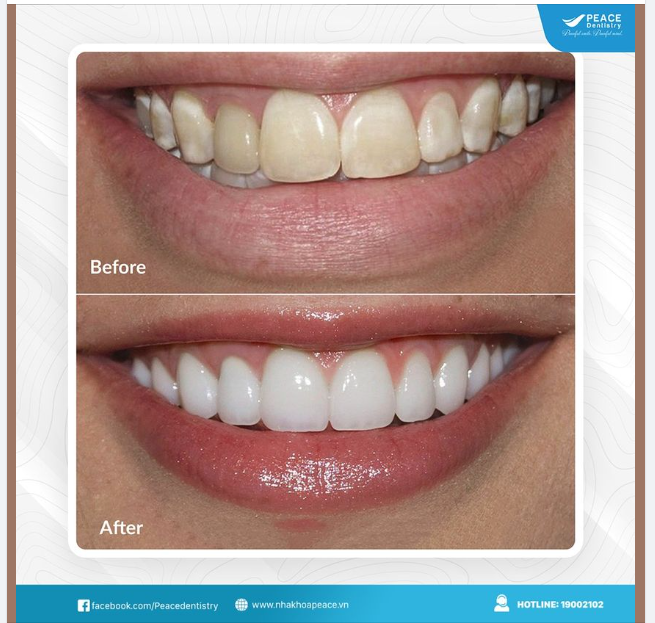 RĂNG TỐI MÀU: BỌC RĂNG SỨ HAY DÁN SỨ VENEER?