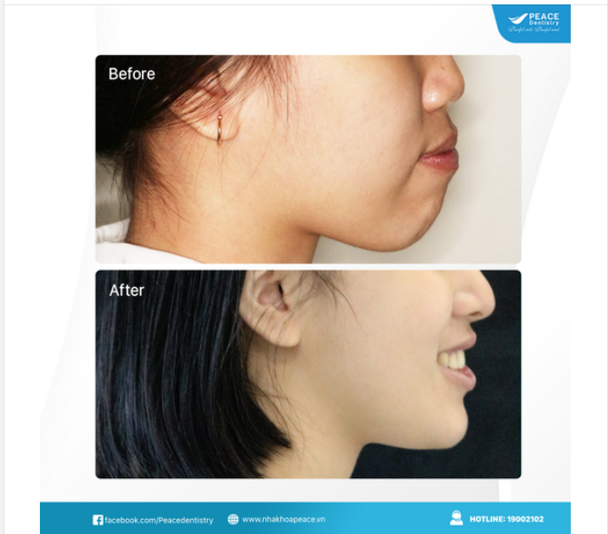 "DẬY THÌ THÀNH CÔNG" NHỜ THAY ĐỔI KHUÔN MẶT SAU KHI NIỀNG RĂNG