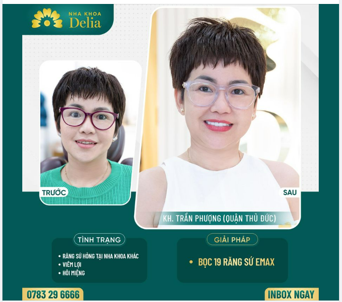 Trước khi đến với Nha Khoa Delia Chị Phượng Trần gặp tình trạng