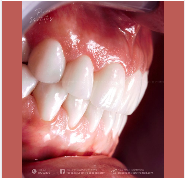 YÊU CẦU VỀ KHỚP CẮN TRONG THẨM MỸ RĂNG SỨ: