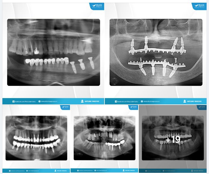 CẦN CẤY BAO NHIÊU TRỤ IMPLANT TRONG CÁC TRƯỜNG HỢP MẤT RĂNG KHÁC NHAU?