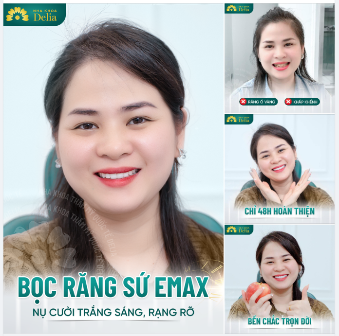 Tặng 10 suất duy nhất Cơ hội thẩm mỹ răng sứ TRỌN BỘ EMAX chỉ 68 triệu - Không giới hạn số lượng răng
