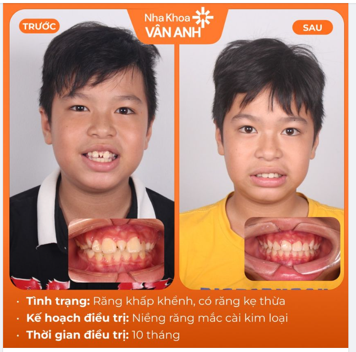 80% BỐ MẸ ĐÃ BỎ LỠ THỜI ĐIỂM VÀNG ĐỂ NIỀNG RĂNG CHO CON.