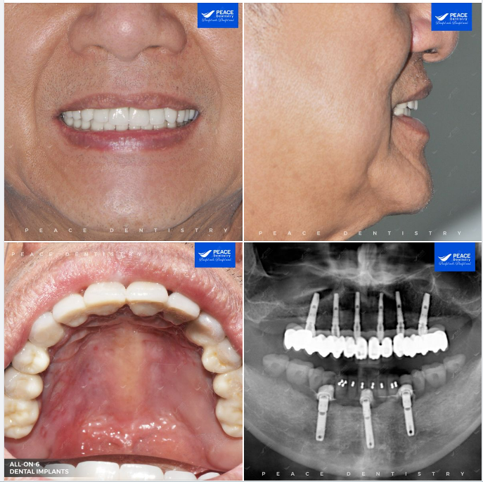 Chúng ta không thể thay đổi tuổi tác của Ba Mẹ, nhưng hoàn toàn có thể lấy lại hàm răng chắc khoẻ và nụ cười tươi tắn của tuổi trẻ!