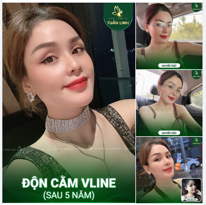 Độn cằm phong thủy - Nâng cấp diện mạo - Phú quý tài lộc