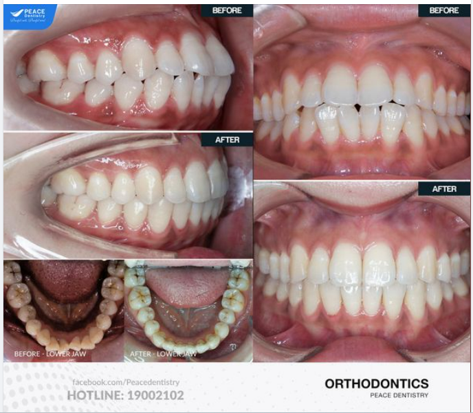 Minh họa là ca lâm sàng niềng răng Invisalign cho tình trạng răng hô, không nhổ răng, không bắt vít và hoàn thành sau 20 tháng.